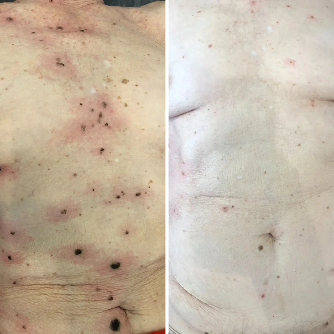 Новообразования в области туловища