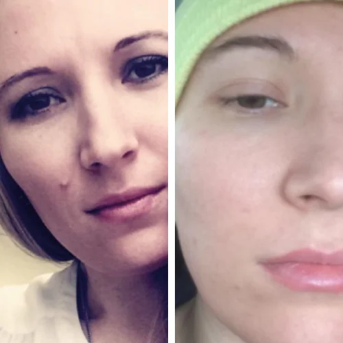 Папиллома на лице