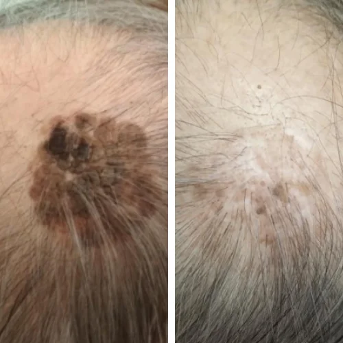 Кератома на волосистой части головы